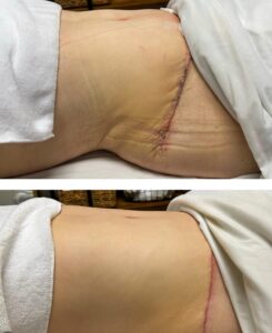 formation drainage lymphatique post-opératoire