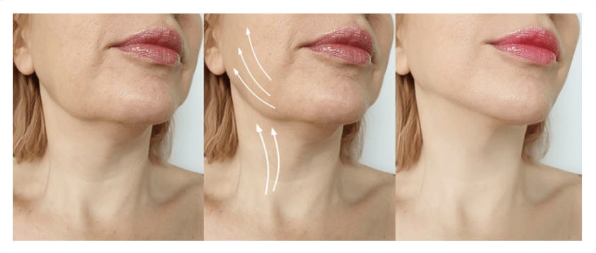 2 radiofrequence img