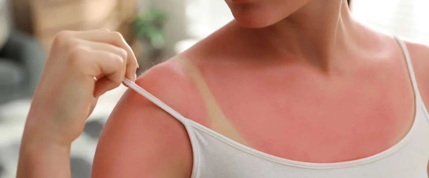 soins de la peau après exposition au soleil
