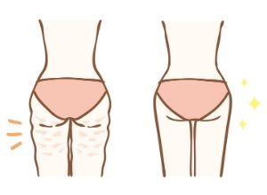 cellulite tissus cutanes