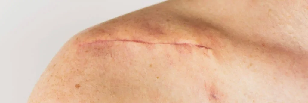 dans quels cas peut on envisager une reprise de cicatrices cover centre de chirurgie dermatologique 2048x688.jpg