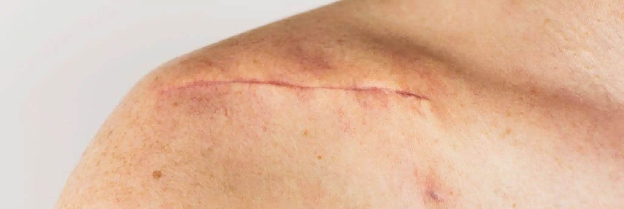 dans quels cas peut on envisager une reprise de cicatrices cover centre de chirurgie dermatologique