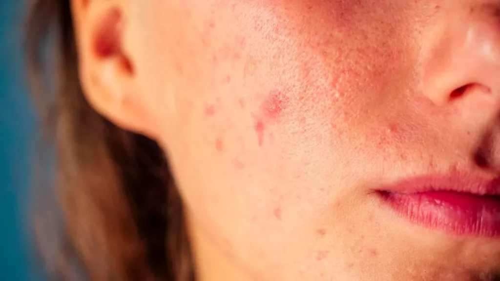 i105691 cinq remedes naturels acne