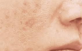 métalothérapie et peau acnéique