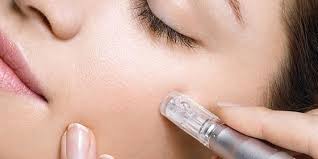 microneedling pour une peau plus belle